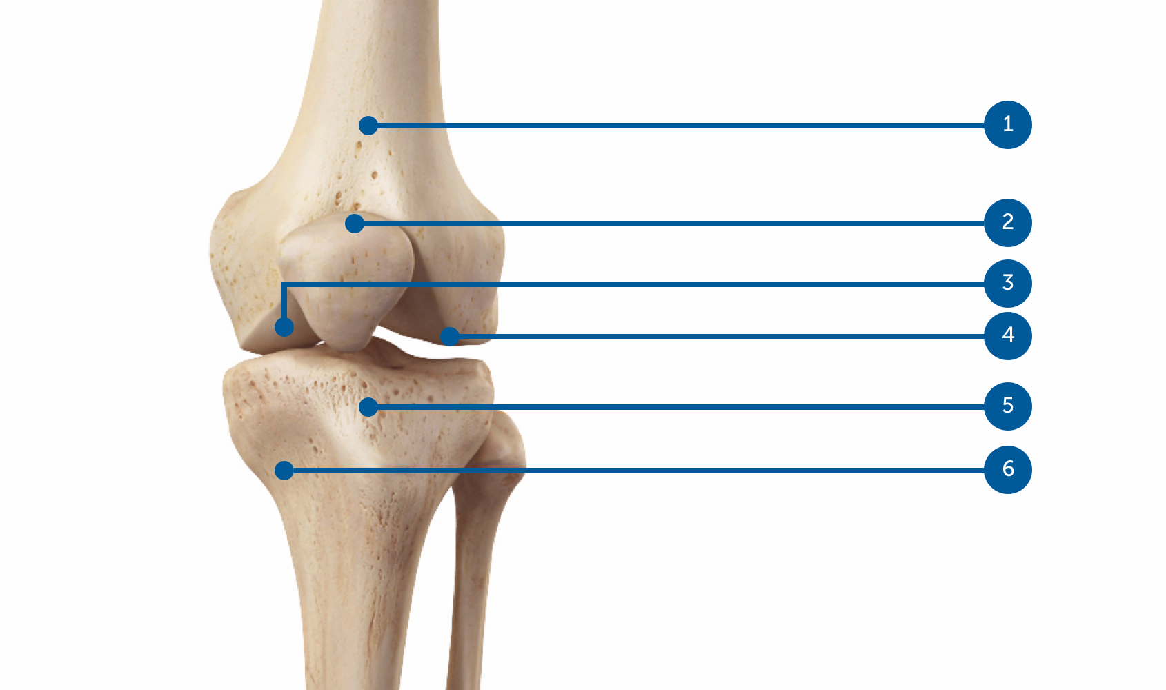 Diagnostic de l'arthrose du genou, comment reconnaître l'arthrose du genou ?